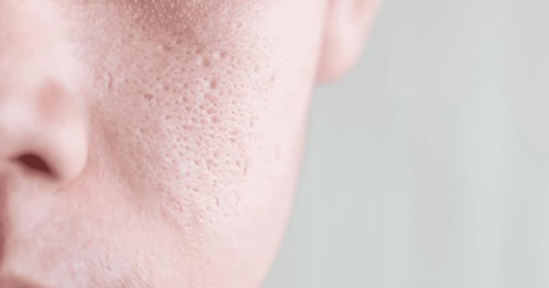 Can Facial Pores Be Completely Erased? Here’s the Truth and Remedies